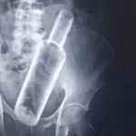 वृद्धकाे पेटभित्र देखियाे ८८४८ भाेड्काकाे बाेतल