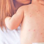 काठमाडाैंमा एक विद्यालयका चार जना विद्यार्थीमा दादुरा पुष्टि